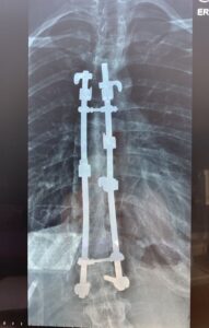 After surgery
